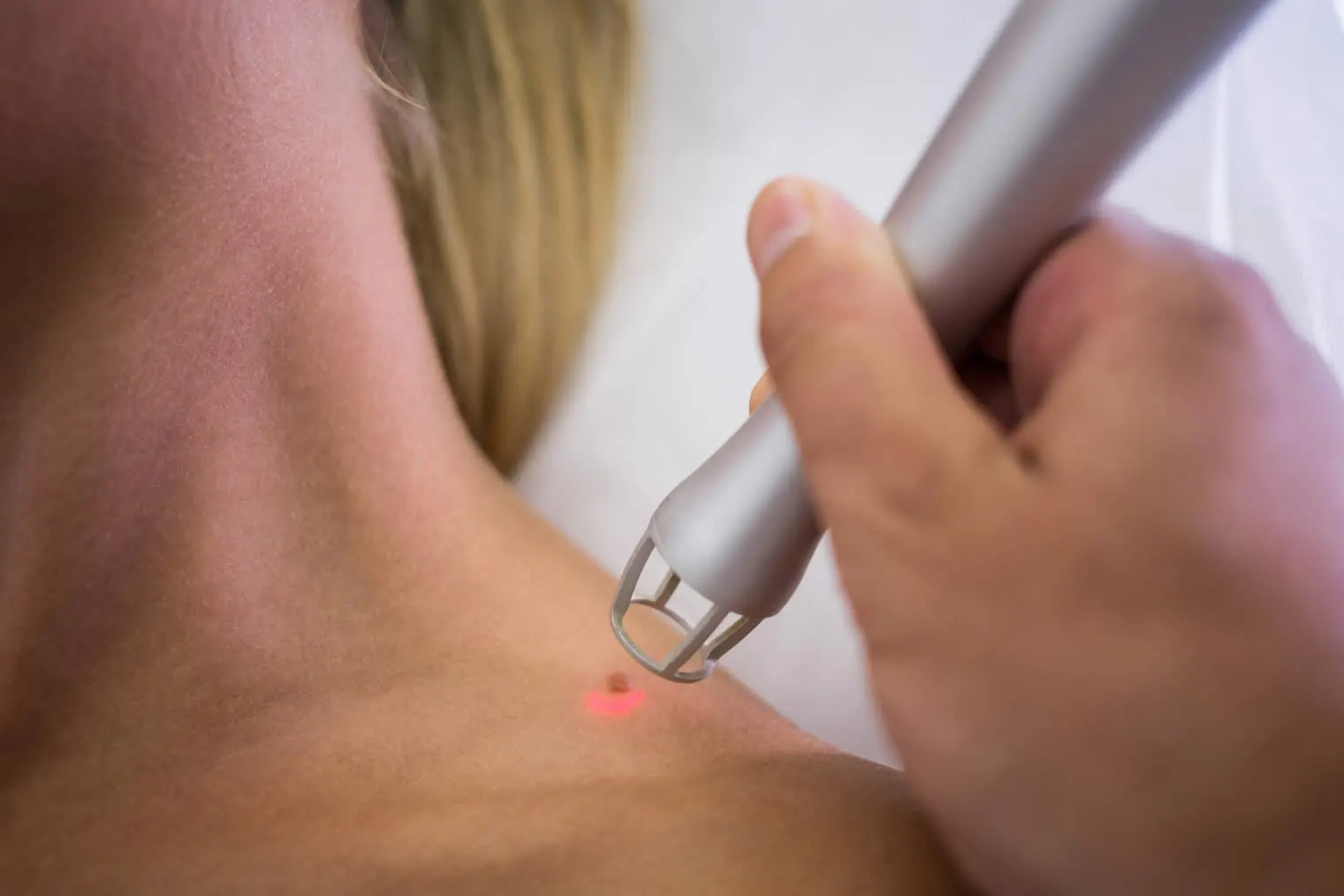 dermatologist-removing-mole-from-womans-shoulder (1)